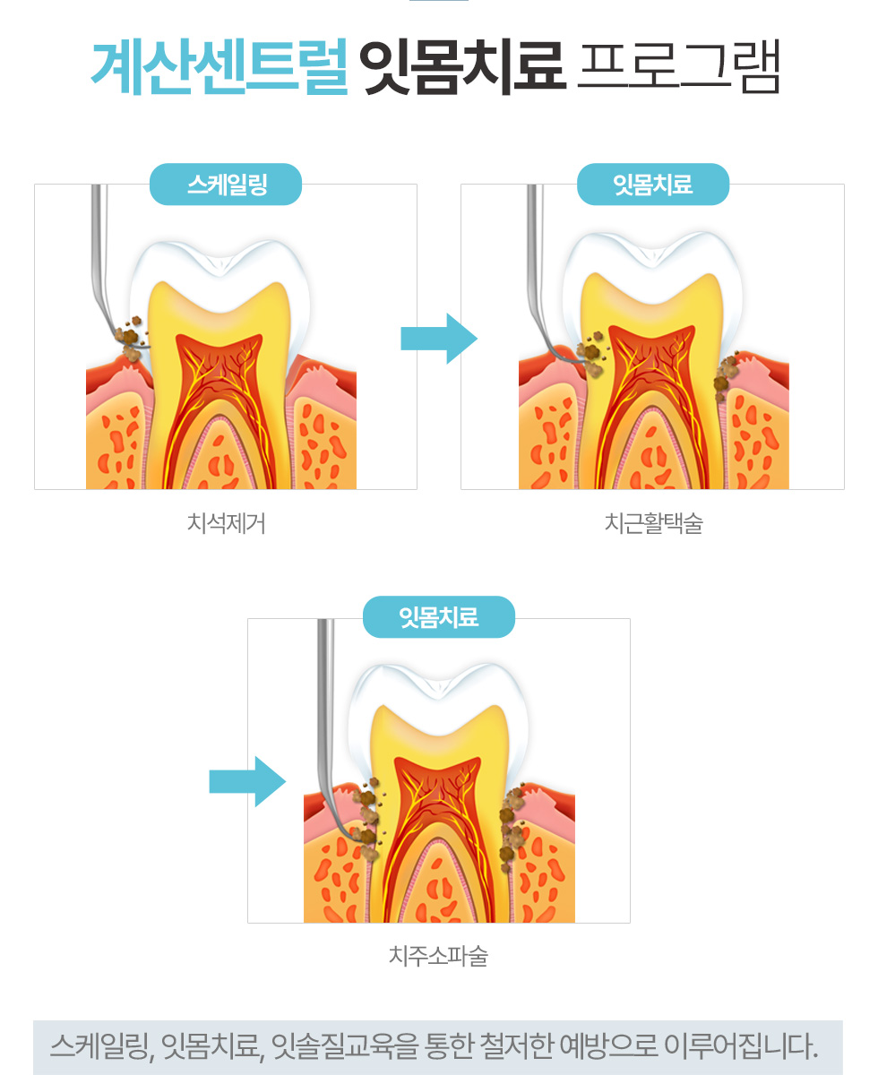계산센트럴 잇몸치료 프로그램