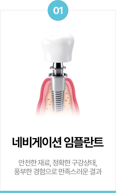 네비게이션 임플란트