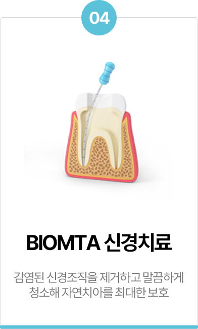 BIOMTA 신경치료