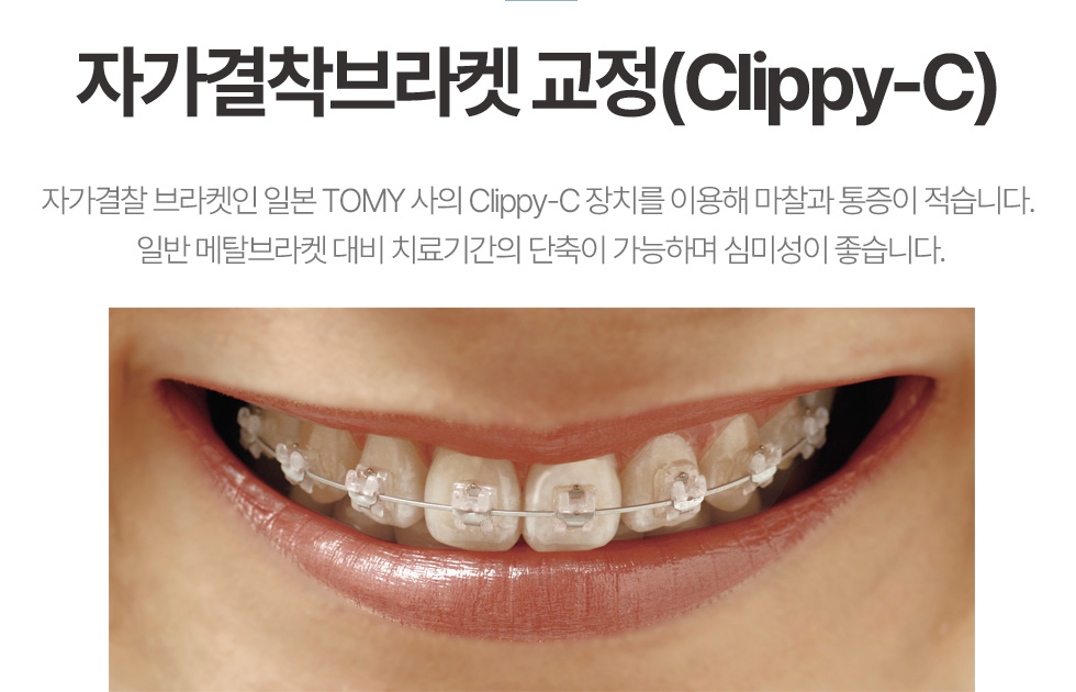 자가결착브라켓 교정(Clippy-C)