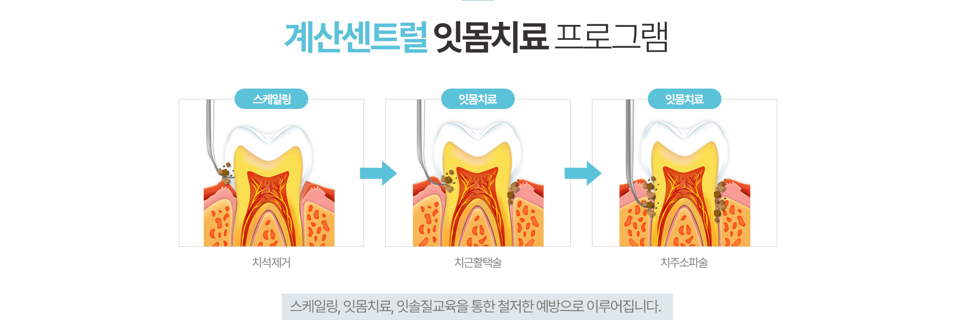 계산센트럴 잇몸치료 프로그램