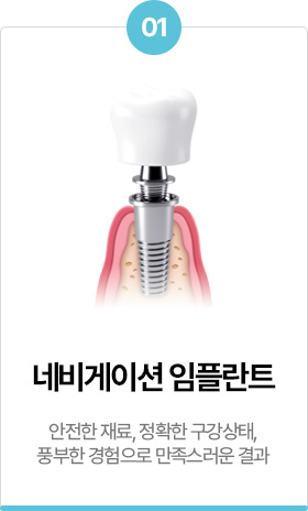 네비게이션 임플란트
