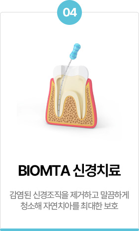 BIOMTA 신경치료