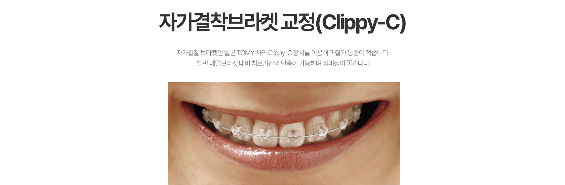 자가결착브라켓 교정(Clippy-C)